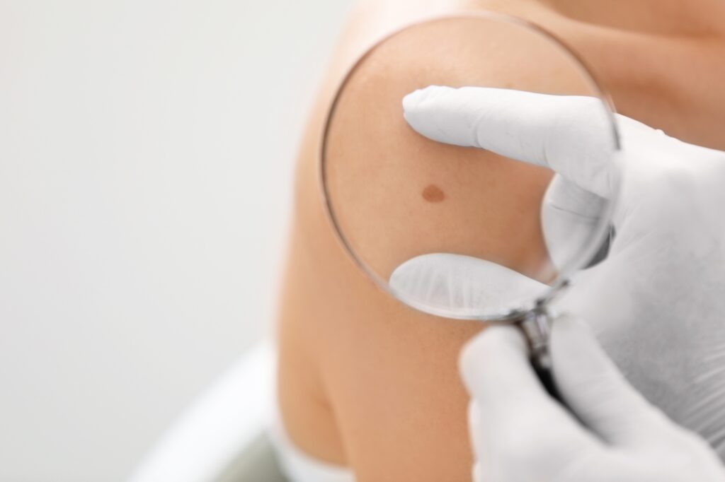 Cirurgia de Câncer de Pele: Conheça as Técnicas e Indicações
